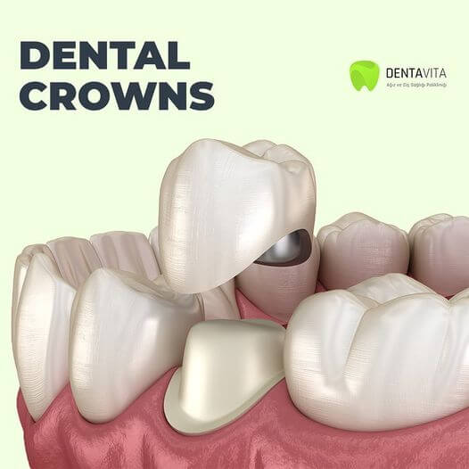 Dental Crowns Istanbul