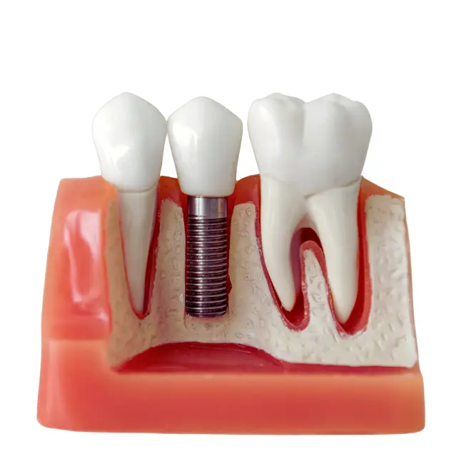 Dental implants istanbul