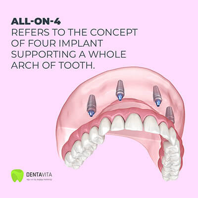 All on 4 dental implants treatment