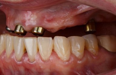 All on four dental implant treatment