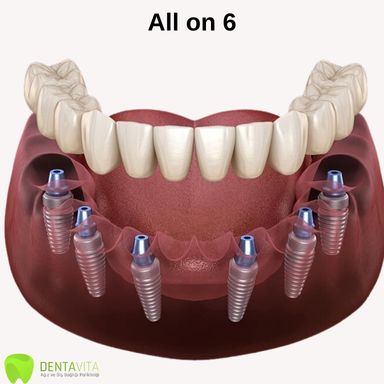 All on 6 dental implant-Turkey