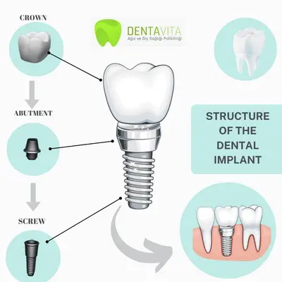 structure-of-dental-implant