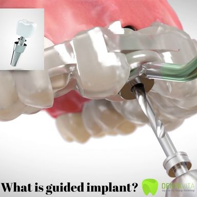 What is guided dental implant?-Turkey