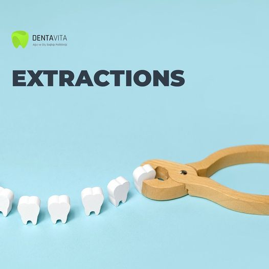 teeth extraction dentist